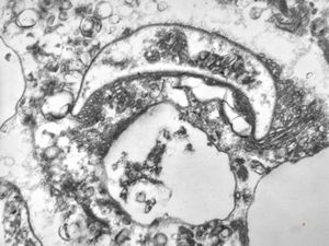 M,50y. | Pneumocystis carinii M,50y. | Pneumocystis carinii